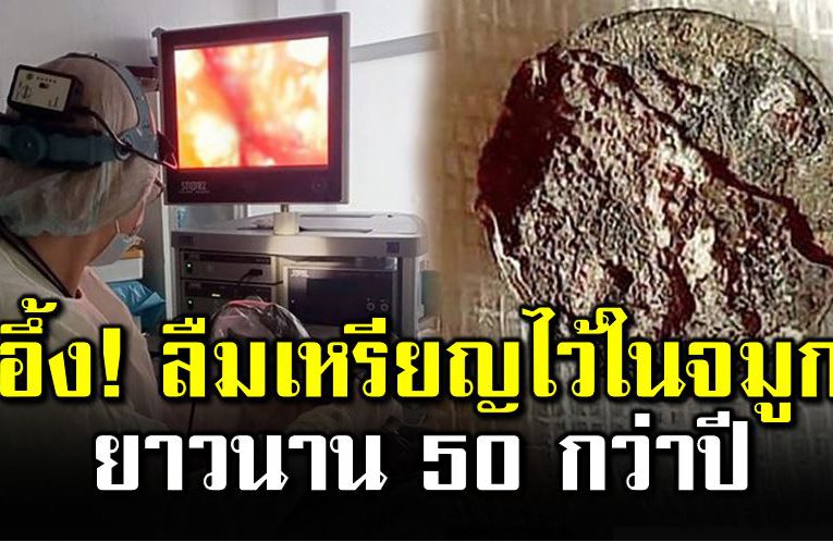 ชายรัสเซียผ่ าตัดนำเหรียญที่ติดจมูกออก หลังลืมไว้นาน 50 กว่าปี