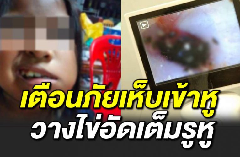เตื อนภั ย เห็บเข้าหูเด็ กหญิง วางไข่อั ดเต็มหู 