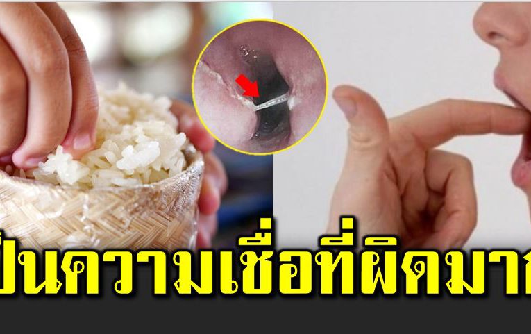 ก้างปลาติดคอ กับวิธีปฐมพย าบาลที่ถูกต้องที่แพทย์แนะนำ