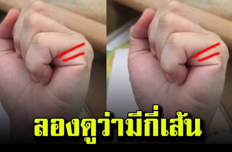 ห มอทั กตรงมาก ยกมือขึ้นดูนะว่ามีกี่เส้น