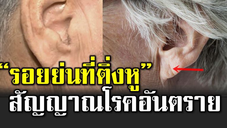 รอยย่ นที่ติ่งหู สัญญ าณเสี่ ยงโร คอันตร าย