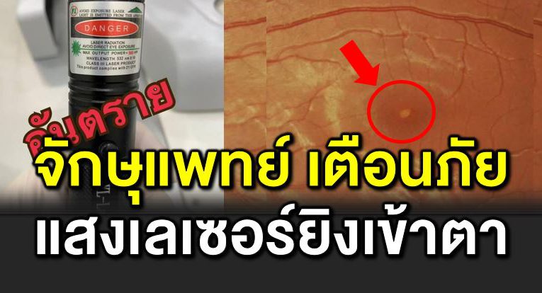 จักษุแพทย์ เตื อนภั ยแสงเลเซอร์ ยิ งเข้าตาถึงกับมองไม่เห็น 