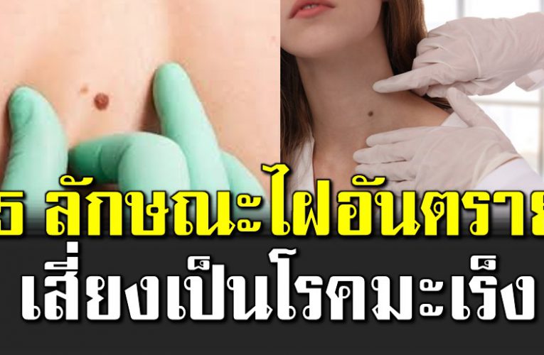 ลักษณะไฝอันตร าย เสี่ ยงเป็นมะเ ร็ง